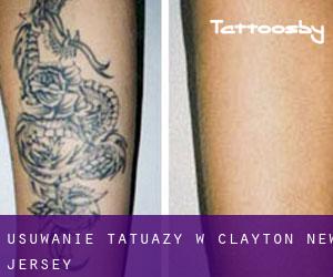 Usuwanie tatuaży w Clayton (New Jersey)