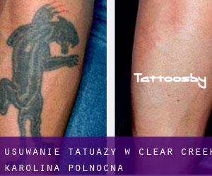Usuwanie tatuaży w Clear Creek (Karolina Północna)