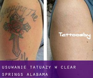 Usuwanie tatuaży w Clear Springs (Alabama)