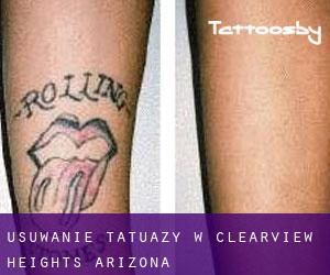 Usuwanie tatuaży w Clearview Heights (Arizona)