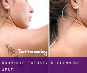 Usuwanie tatuaży w Clemmons West