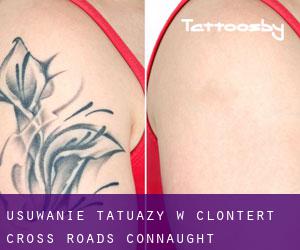 Usuwanie tatuaży w Clontert Cross Roads (Connaught)