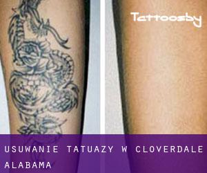 Usuwanie tatuaży w Cloverdale (Alabama)