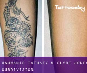 Usuwanie tatuaży w Clyde Jones Subdivision