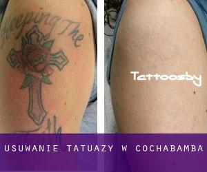 Usuwanie tatuaży w Cochabamba