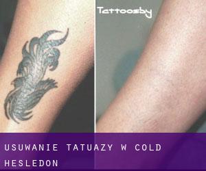 Usuwanie tatuaży w Cold Hesledon