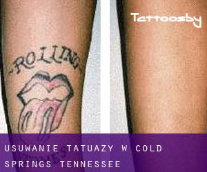 Usuwanie tatuaży w Cold Springs (Tennessee)