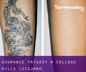 Usuwanie tatuaży w College Hills (Luizjana)