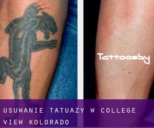 Usuwanie tatuaży w College View (Kolorado)