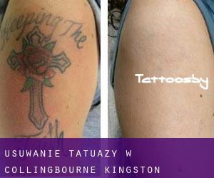 Usuwanie tatuaży w Collingbourne Kingston