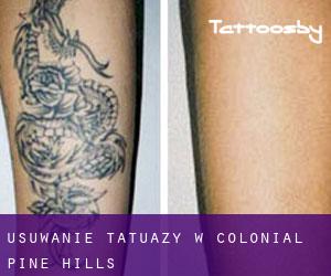 Usuwanie tatuaży w Colonial Pine Hills
