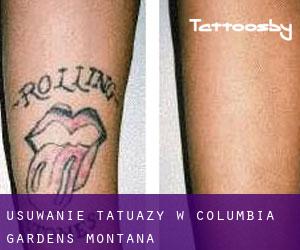 Usuwanie tatuaży w Columbia Gardens (Montana)