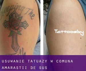 Usuwanie tatuaży w Comuna Amărăştii de Sus