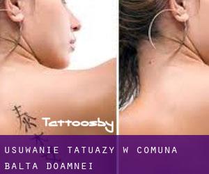 Usuwanie tatuaży w Comuna Balta Doamnei