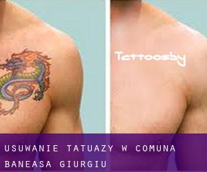 Usuwanie tatuaży w Comuna Băneasa (Giurgiu)