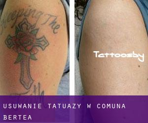 Usuwanie tatuaży w Comuna Bertea