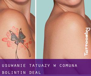 Usuwanie tatuaży w Comuna Bolintin Deal