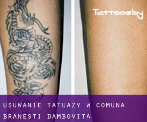 Usuwanie tatuaży w Comuna Brăneşti (Dâmboviţa)