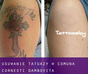 Usuwanie tatuaży w Comuna Corneşti (Dâmboviţa)