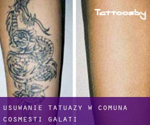 Usuwanie tatuaży w Comuna Cosmeşti (Galaţi)