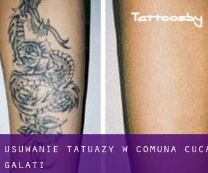 Usuwanie tatuaży w Comuna Cuca (Galaţi)