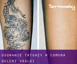 Usuwanie tatuaży w Comuna Deleni (Vaslui)
