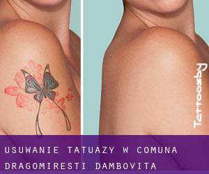 Usuwanie tatuaży w Comuna Dragomireşti (Dâmboviţa)