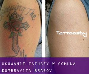 Usuwanie tatuaży w Comuna Dumbrăviţa (Braşov)