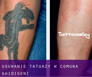 Usuwanie tatuaży w Comuna Ghidigeni
