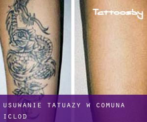 Usuwanie tatuaży w Comuna Iclod