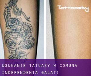 Usuwanie tatuaży w Comuna Independenţa (Galaţi)