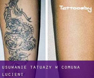 Usuwanie tatuaży w Comuna Lucieni