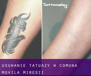 Usuwanie tatuaży w Comuna Movila Miresii