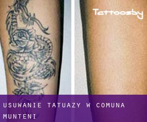 Usuwanie tatuaży w Comuna Munteni
