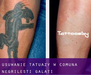 Usuwanie tatuaży w Comuna Negrileşti (Galaţi)