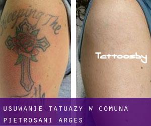 Usuwanie tatuaży w Comuna Pietroşani (Argeş)