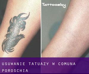 Usuwanie tatuaży w Comuna Poroschia
