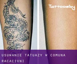 Usuwanie tatuaży w Comuna Răcăciuni
