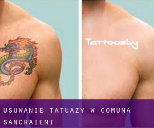 Usuwanie tatuaży w Comuna Sâncrăieni