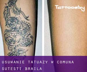Usuwanie tatuaży w Comuna Şuţeşti (Brăila)