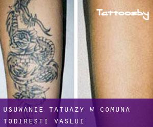 Usuwanie tatuaży w Comuna Todireşti (Vaslui)