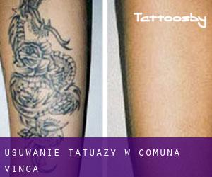 Usuwanie tatuaży w Comuna Vinga