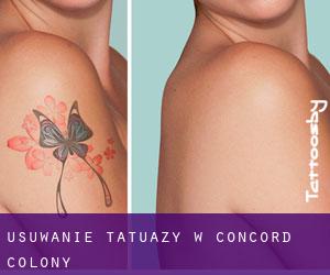 Usuwanie tatuaży w Concord Colony