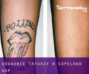 Usuwanie tatuaży w Copeland Gap