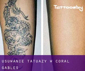Usuwanie tatuaży w Coral Gables