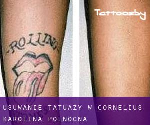 Usuwanie tatuaży w Cornelius (Karolina Północna)