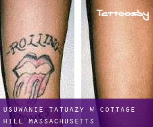 Usuwanie tatuaży w Cottage Hill (Massachusetts)
