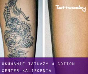 Usuwanie tatuaży w Cotton Center (Kalifornia)