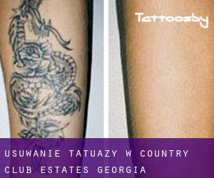 Usuwanie tatuaży w Country Club Estates (Georgia)