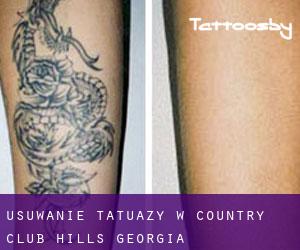 Usuwanie tatuaży w Country Club Hills (Georgia)